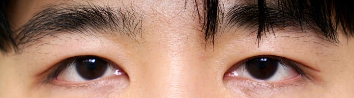 절개법쌍꺼풀 눈매교정 쌍꺼풀재수술 수술 후 359