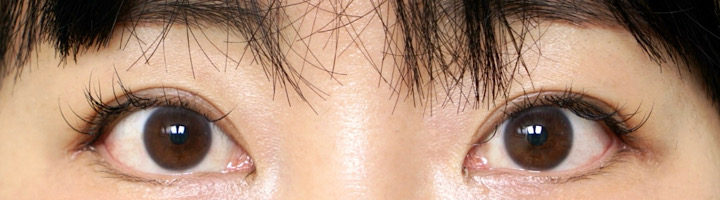 뒤트임 수술 후 290