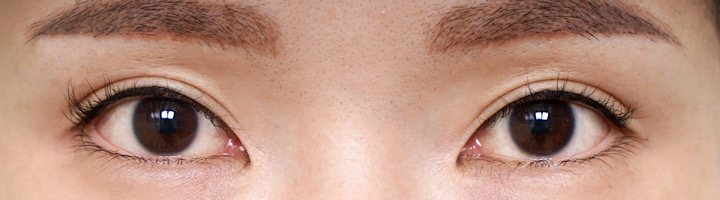 뒤트임 밑트임 수술 전 384