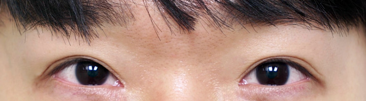 앞트임복원 수술 후 247