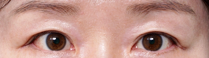 뒤트임복원 뒤트임 수술 후 407