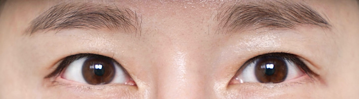 뒤트임복원 뒤트임 수술 후 351