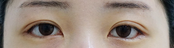뒤트임 밑트임 수술 후 74