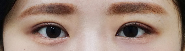 자연유착쌍꺼풀 수술 후 149