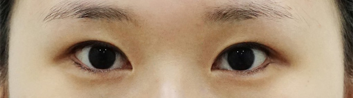 밑트임 수술 전 24