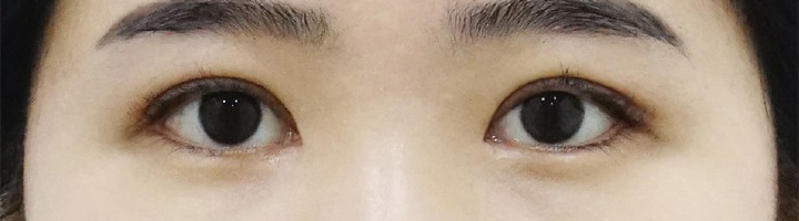 앞트임 뒤트임 윗트임 밑트임 수술 후 145