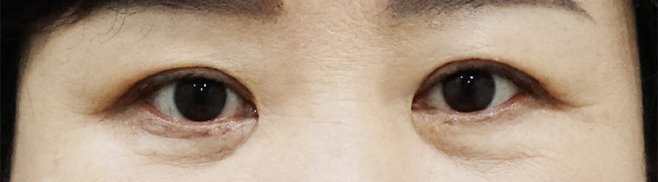 눈밑지방재배치 상안검성형술 하안검성형술 수술 후 2