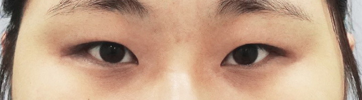 절개법쌍꺼풀 수술 전 172