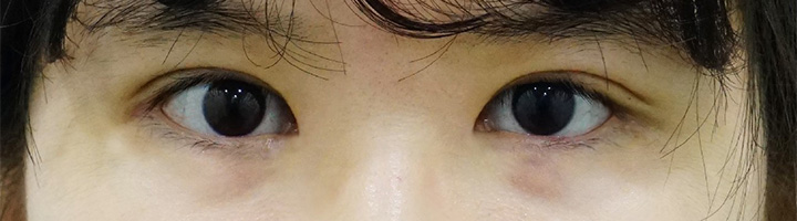 뒤트임 윗트임 밑트임 눈매교정 수술 후 86