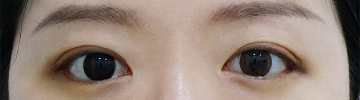 뒤트임 밑트임 수술 후 58