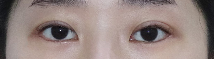 뒤트임 밑트임 눈매교정 수술 후 128