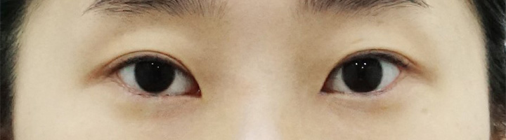 뒤트임 밑트임 눈매교정 수술 전 128