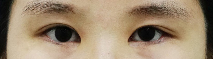 앞트임 뒤트임 윗트임 밑트임 눈매교정 수술 전 109