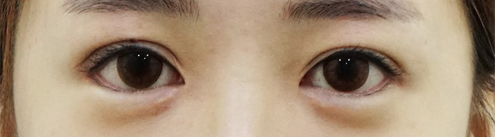 앞트임 뒤트임 밑트임 수술 후 20
