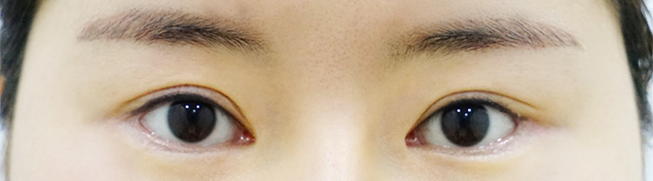 뒤트임 밑트임 수술 후 41