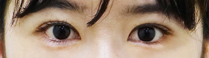 앞트임 윗트임 수술 후 96