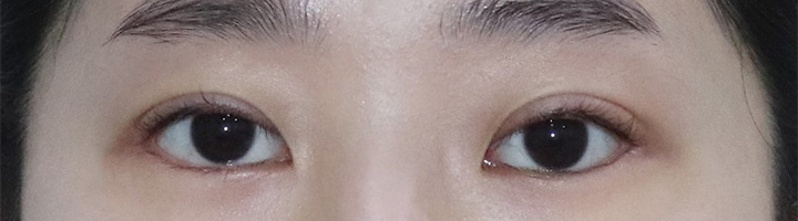 자연유착쌍꺼풀 수술 후 162