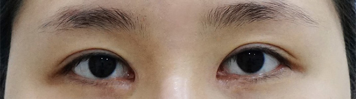 앞트임복원 윗트임 수술 전 102
