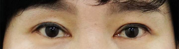 눈매교정 상안검성형술 수술 후 4