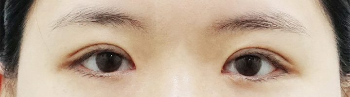 앞트임 수술 후 98