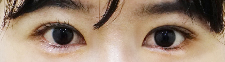 앞트임 윗트임 수술 후 120