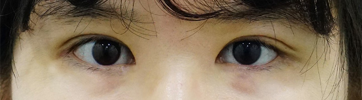 뒤트임 윗트임 밑트임 눈매교정 수술 후 3