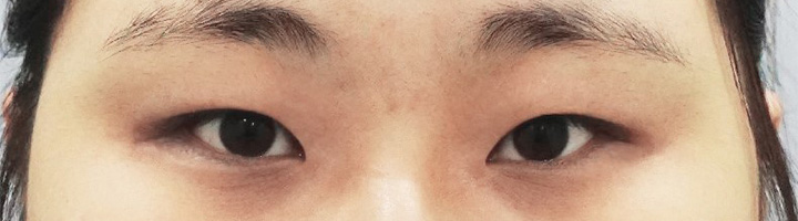 뒤트임 윗트임 밑트임 절개법쌍꺼풀 수술 전 68