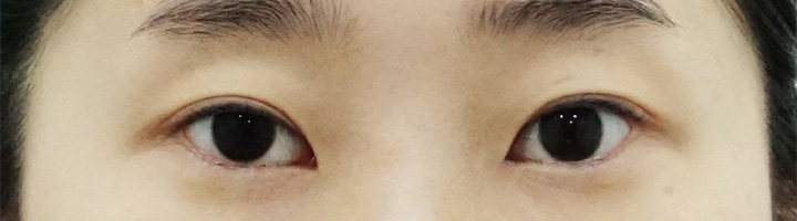 뒤트임 밑트임 눈매교정 수술 전 33