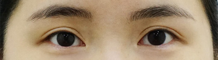 뒤트임 밑트임 수술 전 63