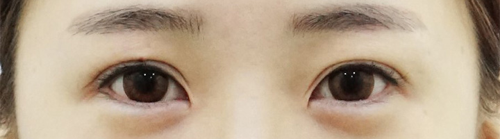 앞트임 뒤트임 밑트임 수술 전 66