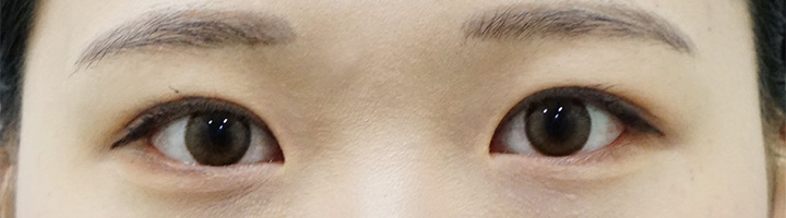 뒤트임 밑트임 절개법쌍꺼풀 수술 후 65