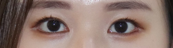 밑트임 수술 후 24