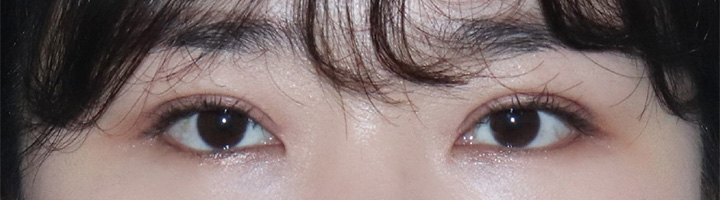 절개법쌍꺼풀 수술 후 164