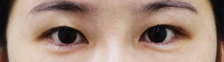 자연유착쌍꺼풀 수술 전 159