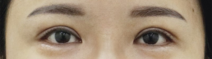 뒤트임 윗트임 밑트임 수술 후 118