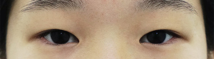 앞트임 눈매교정 수술 전 125