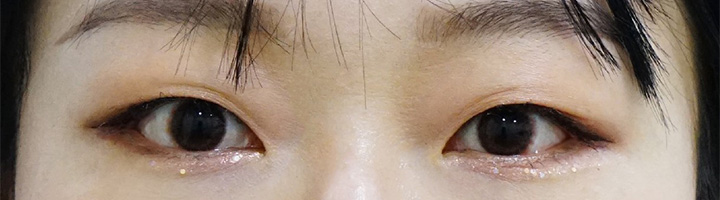 뒤트임 밑트임 수술 후 23