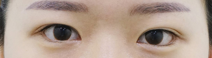 밑트임 수술 후 52