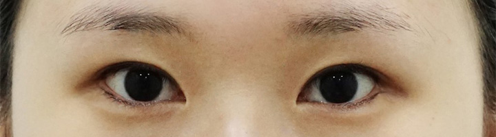 밑트임 수술 전 70