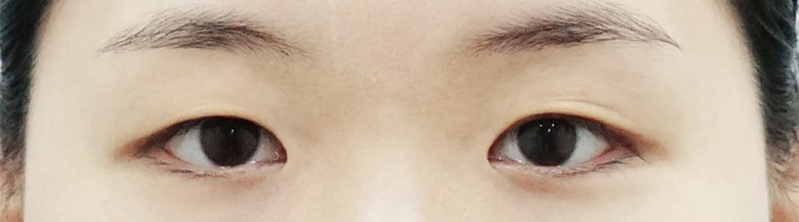 자연유착쌍꺼풀 수술 전 163
