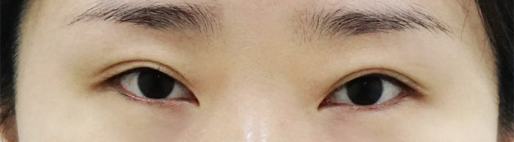 뒤트임 밑트임 눈매교정 수술 전 122