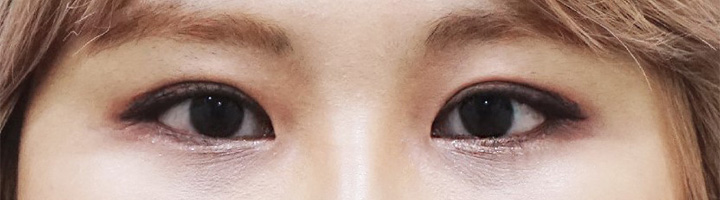 뒤트임 윗트임 밑트임 절개법쌍꺼풀 수술 후 111