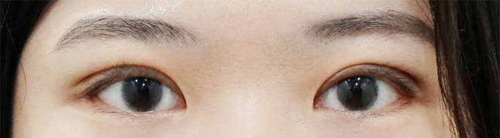 뒤트임 절개법쌍꺼풀 수술 후 17