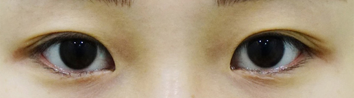 자연유착쌍꺼풀 수술 전 153