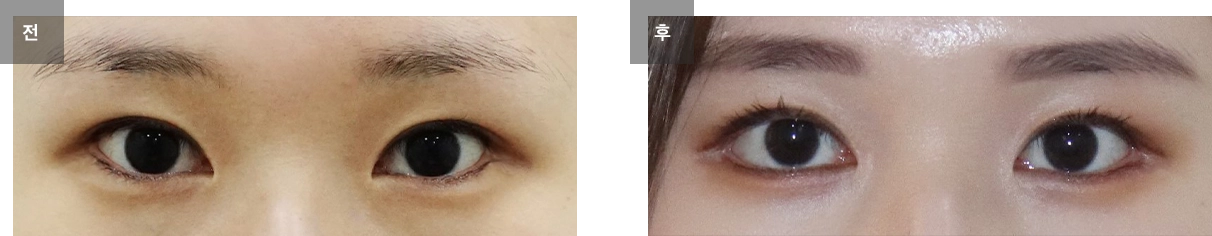 뒤트임 수술 케이스 #18
