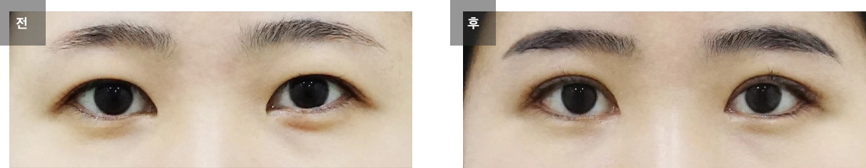 절개법 쌍꺼풀 수술 전후사진 #2