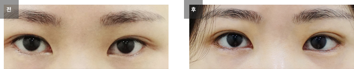 눈밑지방재배치 / 하안검 성형술 전후사진 #2