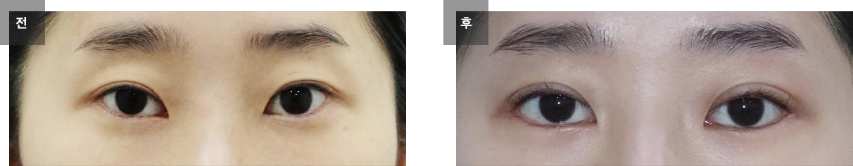 자연유착 쌍꺼풀 수술 케이스 #12