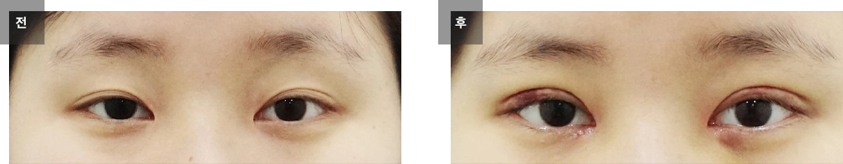 자연유착 쌍꺼풀 수술 케이스 #15