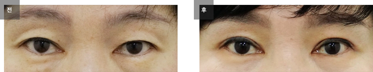 눈매교정 수술 전후사진 #1
